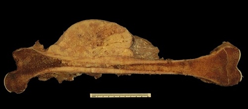 Osteosarcoma