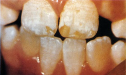 Figure 3. – Examples of dental fluorosis in 8- and 9-year old children who grew up in fluoridated Auckland, New Zealand.