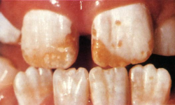 Figure 3. – Examples of dental fluorosis in 8- and 9-year old children who grew up in fluoridated Auckland, New Zealand.