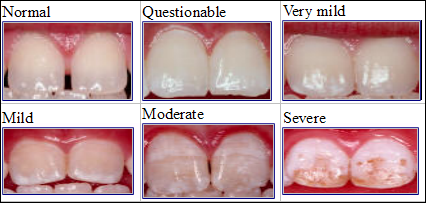 CDC dental fluorosis comparisonphotos