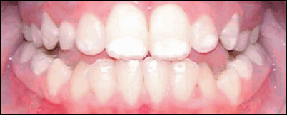 The plaintiff's teeth in the Nemphos v. Nestle suit (2013), an example of mild dental fluorosis. Photo - Nidel Law.